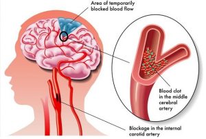 Global Acute Ischemic Stroke Market Capacity, Production And Share By Manufacturers 2018-2023