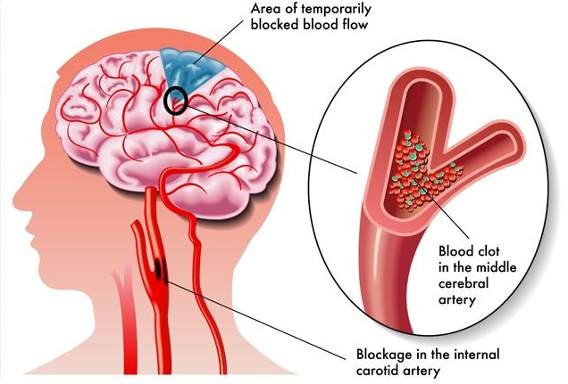 Global Acute Ischemic Stroke Market Capacity, Production And Share By Manufacturers 2018-2023<span class="rating-result after_title mr-filter rating-result-3709">			<span class="no-rating-results-text">No ratings yet.</span>		</span>