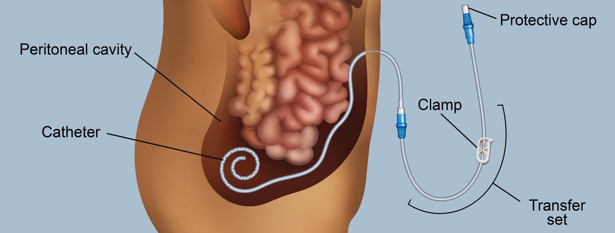 Global Peritoneal Dialysis Market was valued at USD 3.18 Billion in 2017 and is projected to reach USD 4.97 Billion by 2025<span class="rating-result after_title mr-filter rating-result-5787">			<span class="no-rating-results-text">No ratings yet.</span>		</span>