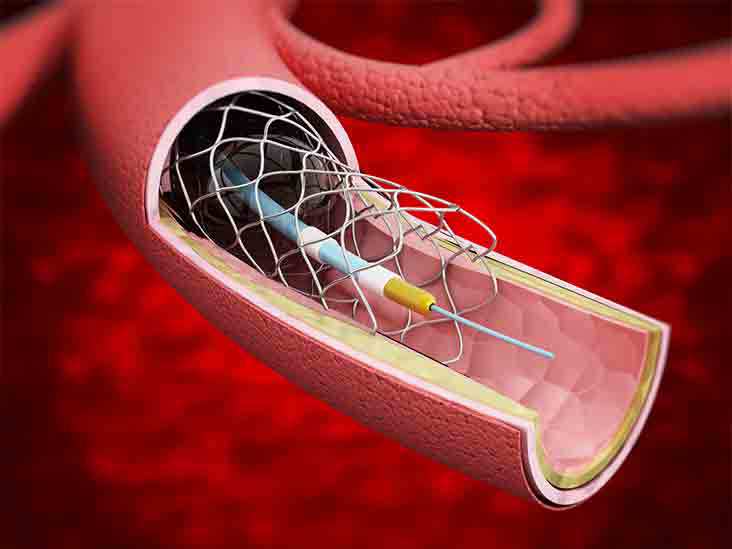 Global Stents Industry Size, Share, Growth, Analysis & Market Demand<span class="rating-result after_title mr-filter rating-result-4442">			<span class="no-rating-results-text">No ratings yet.</span>		</span>