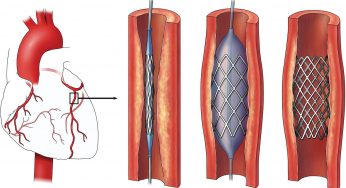 Global Coronary Stent Market By Regions, Type And Application, Forecast 2023