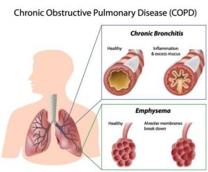 <span class="entry-title-primary">Asthma and COPD Market 2019 Global Leading Players, Industry Updates, Future Growth, Business Prospects, Forthcoming Developments and Future Investments by Forecast to 2023</span> <span class="entry-subtitle">Global Asthma and COPD Market – Planet Market Reports</span>