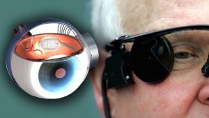 Bionic Eye Market Global Scenario, Market Size, Outlook, Trend and Forecast