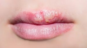 <span class="entry-title-primary">Global Drugs for Oral Herpes Market Key Players, Trends, Share, Industry Size, Growth, Opportunities, Forecast To 2024</span> <span class="entry-subtitle">Drugs for Oral Herpes Market</span>