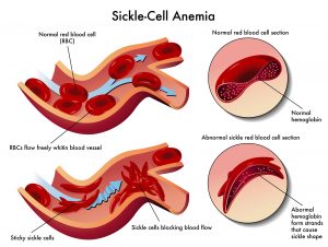 <span class="entry-title-primary">Anemia Treatment Market share, size, regions, revenue, types, applications and forecast 2019-2024</span> <span class="entry-subtitle">Anemia Treatment- Industry Outlook and Growth by 2024</span>