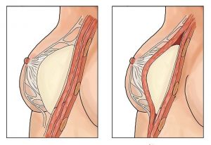 <span class="entry-title-primary">Breast Reconstruction and Augmentation Market Report with Regions, SWOT Analysis and CAGR Analysis</span> <span class="entry-subtitle">Breast Reconstruction and Augmentation Industry Analysis and Forecast – 2025</span>