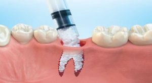 <span class="entry-title-primary">Dental Bone Graft Substitute and Other Bio-materials Market Growth Analysis, Share, Demand by Regions, Types and Analysis of Key Players- Research</span> <span class="entry-subtitle">Dental Bone Graft Substitute and Other Bio-materials Industry Size and Share with Forecast by 2024</span>