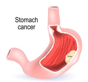 <span class="entry-title-primary">Gastric Cancer Testing, Treatment and Prevention Industry Analysis and Forecast – 2025</span> <span class="entry-subtitle">Gastric Cancer Testing, Treatment and Prevention Market Scope and Market Expected 2018-2023</span>