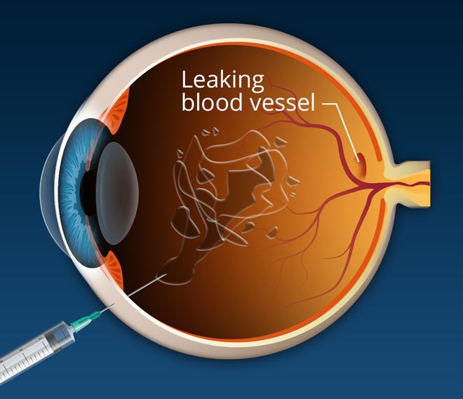 <span class="entry-title-primary">Macular Degeneration Treatment Market Growth Rate, Demands, Status and Application Forecast to 2024</span> <span class="entry-subtitle">Macular Degeneration Treatment Industry Report Analysis by Planet Market</span><span class="rating-result after_title mr-filter rating-result-11059">	<span class="mr-star-rating">			    <i class="fa fa-star mr-star-full"></i>	    	    <i class="fa fa-star mr-star-full"></i>	    	    <i class="fa fa-star mr-star-full"></i>	    	    <i class="fa fa-star mr-star-full"></i>	    	    <i class="fa fa-star mr-star-full"></i>	    </span><span class="star-result">	5/5</span>			<span class="count">				(1)			</span>			</span>