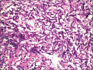 <span class="entry-title-primary">Mucormycosis Market 2019 Share, Trend, Segmentation and Forecast to 2025</span> <span class="entry-subtitle">Global Mucormycosis Market</span>