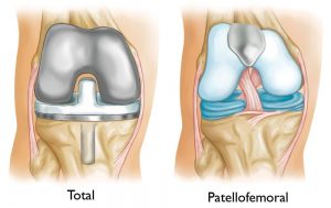 <span class="entry-title-primary">Patello-Femoral Prostheses Market Size, Share Growth Trend and Forecast 2024</span> <span class="entry-subtitle">Patello-Femoral Prostheses Industry report Analysis</span>