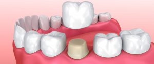 <span class="entry-title-primary">Porcelain-fused-to-metal Dental Crowns Market Size, Analytical Overview, Growth Factors, Demand, Trends and Forecast to 2024</span> <span class="entry-subtitle">Porcelain-fused-to-metal Dental Crowns Industry Forecast</span>