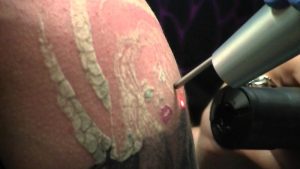 <span class="entry-title-primary">Tattoo Removal Lasers Market Report 2018-2023 Emerging Key Players by Types, Applications and Regions</span> <span class="entry-subtitle">Tattoo Removal Lasers Market Report with Regions, SWOT Analysis and CAGR Analysis</span>