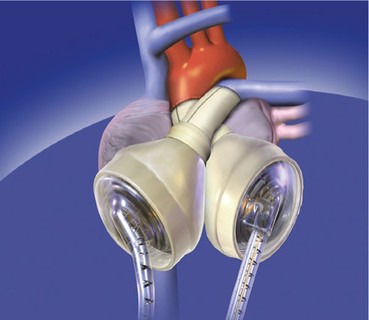 <span class="entry-title-primary">Total Artificial Heart Market Report Segmented by Application, Region, Key Players and Porters Five Forces Analysis</span> <span class="entry-subtitle">Total Artificial Heart Industry Analysis and Forecast - 2025</span><span class="rating-result after_title mr-filter rating-result-11917">	<span class="mr-star-rating">			    <i class="fa fa-star mr-star-full"></i>	    	    <i class="fa fa-star mr-star-full"></i>	    	    <i class="fa fa-star mr-star-full"></i>	    	    <i class="fa fa-star mr-star-full"></i>	    	    <i class="fa fa-star mr-star-full"></i>	    </span><span class="star-result">	5/5</span>			<span class="count">				(1)			</span>			</span>