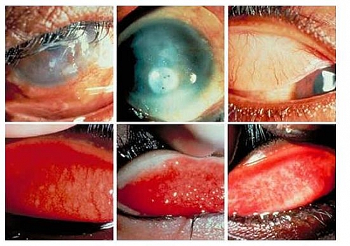 <span class="entry-title-primary">Trachoma Treatments Market Report with Regions, SWOT Analysis and CAGR Analysis</span> <span class="entry-subtitle">Trachoma Treatments Industry Forecast, 2022</span><span class="rating-result after_title mr-filter rating-result-11206">	<span class="mr-star-rating">			    <i class="fa fa-star mr-star-full"></i>	    	    <i class="fa fa-star mr-star-full"></i>	    	    <i class="fa fa-star mr-star-full"></i>	    	    <i class="fa fa-star mr-star-full"></i>	    	    <i class="fa fa-star mr-star-full"></i>	    </span><span class="star-result">	5/5</span>			<span class="count">				(1)			</span>			</span>