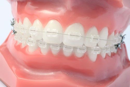 <span class="entry-title-primary">Ceramic Braces Market Growth Analysis, Share, Demand by Regions, Types and Analysis of Key Players- Research</span> <span class="entry-subtitle">Research On Ceramic Braces Market Report 2019 to 2024</span><span class="rating-result after_title mr-filter rating-result-13913">	<span class="mr-star-rating">			    <i class="fa fa-star mr-star-full"></i>	    	    <i class="fa fa-star mr-star-full"></i>	    	    <i class="fa fa-star mr-star-full"></i>	    	    <i class="fa fa-star mr-star-full"></i>	    	    <i class="fa fa-star mr-star-full"></i>	    </span><span class="star-result">	5/5</span>			<span class="count">				(1)			</span>			</span>