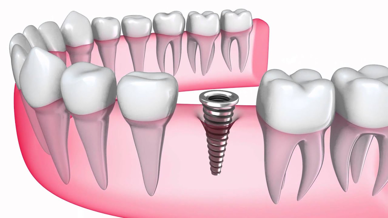 <span class="entry-title-primary">Dental Implant Prostheses Market Scope and Market Expected 2019-2023</span> <span class="entry-subtitle">Dental Implant Prostheses SWOT Analysis and CAGR Analysis</span><span class="rating-result after_title mr-filter rating-result-14890">	<span class="mr-star-rating">			    <i class="fa fa-star mr-star-full"></i>	    	    <i class="fa fa-star mr-star-full"></i>	    	    <i class="fa fa-star mr-star-full"></i>	    	    <i class="fa fa-star mr-star-full"></i>	    	    <i class="fa fa-star mr-star-full"></i>	    </span><span class="star-result">	5/5</span>			<span class="count">				(1)			</span>			</span>