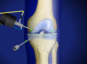 <span class="entry-title-primary">Keyhole Orthopaedic Surgery Instruments Market Insights, Forecast To 2025 Size And Trends</span> <span class="entry-subtitle">Keyhole Orthopaedic Surgery Instruments</span><span class="rating-result after_title mr-filter rating-result-15138">	<span class="mr-star-rating">			    <i class="fa fa-star mr-star-full"></i>	    	    <i class="fa fa-star mr-star-full"></i>	    	    <i class="fa fa-star mr-star-full"></i>	    	    <i class="fa fa-star mr-star-full"></i>	    	    <i class="fa fa-star mr-star-full"></i>	    </span><span class="star-result">	5/5</span>			<span class="count">				(1)			</span>			</span>