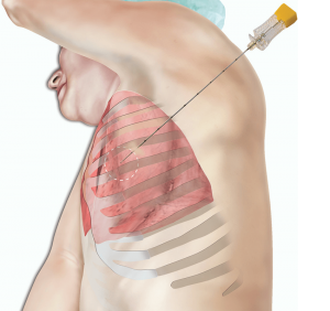 <span class="entry-title-primary">Lung Biopsy Systems Market Analysis and Forecast 2019-2025 by Planet Market Reports</span> <span class="entry-subtitle"> Industry Overview Of Lung Biopsy Systems Market</span>