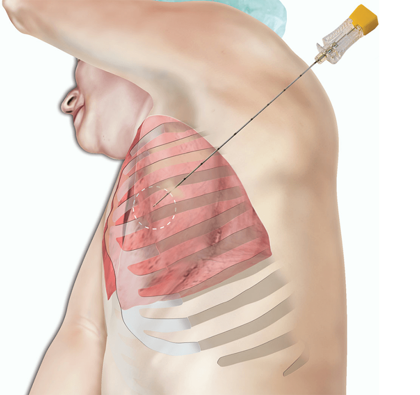 <span class="entry-title-primary">Lung Biopsy Systems Market Analysis and Forecast 2019-2025 by Planet Market Reports</span> <span class="entry-subtitle"> Industry Overview Of Lung Biopsy Systems Market</span><span class="rating-result after_title mr-filter rating-result-15621">	<span class="mr-star-rating">			    <i class="fa fa-star mr-star-full"></i>	    	    <i class="fa fa-star mr-star-full"></i>	    	    <i class="fa fa-star mr-star-full"></i>	    	    <i class="fa fa-star mr-star-full"></i>	    	    <i class="fa fa-star mr-star-full"></i>	    </span><span class="star-result">	5/5</span>			<span class="count">				(1)			</span>			</span>