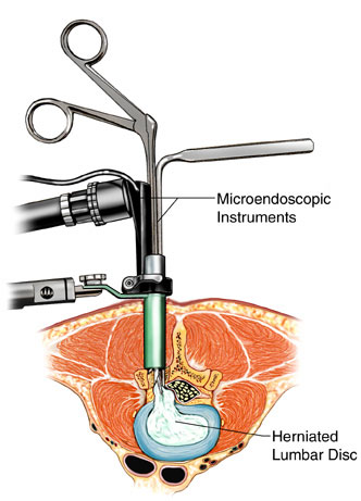 <span class="entry-title-primary">Minimally Invasive Spine Surgery Market Is Expected To Reach $17.3 Billion By 2024</span> <span class="entry-subtitle">Minimally Invasive Spine Surgery Industry Report Analysis</span><span class="rating-result after_title mr-filter rating-result-15282">	<span class="mr-star-rating">			    <i class="fa fa-star mr-star-full"></i>	    	    <i class="fa fa-star mr-star-full"></i>	    	    <i class="fa fa-star mr-star-full"></i>	    	    <i class="fa fa-star mr-star-full"></i>	    	    <i class="fa fa-star mr-star-full"></i>	    </span><span class="star-result">	5/5</span>			<span class="count">				(1)			</span>			</span>