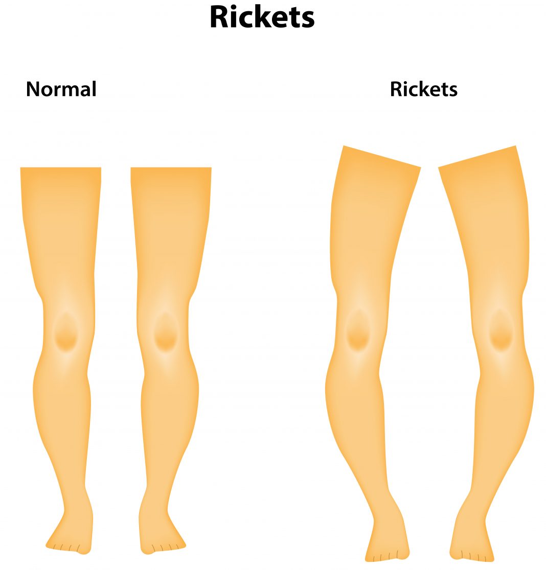 <span class="entry-title-primary">Rickets Market Is Expected To Grow At A CAGR Over 9.7% From 2019 To 2024</span> <span class="entry-subtitle">Rickets Industry Growth</span><span class="rating-result after_title mr-filter rating-result-15668">			<span class="no-rating-results-text">No ratings yet.</span>		</span>