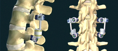 <span class="entry-title-primary">Spinal Motion Preservation Device Market to reach US$ 3.78 Billion by 2025</span> <span class="entry-subtitle">Spinal Motion Preservation Device Industry Report Analysis</span><span class="rating-result after_title mr-filter rating-result-15000">	<span class="mr-star-rating">			    <i class="fa fa-star mr-star-full"></i>	    	    <i class="fa fa-star mr-star-full"></i>	    	    <i class="fa fa-star mr-star-full"></i>	    	    <i class="fa fa-star mr-star-full"></i>	    	    <i class="fa fa-star mr-star-full"></i>	    </span><span class="star-result">	5/5</span>			<span class="count">				(1)			</span>			</span>