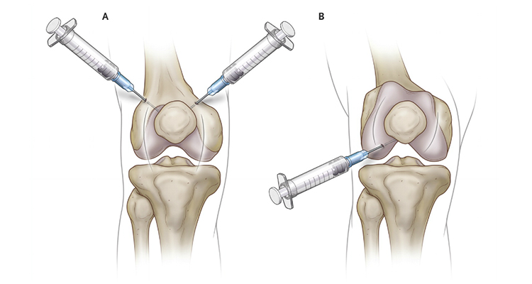 <span class="entry-title-primary">Viscosupplementation Treatment for Arthritis Market Research Report | Latest Trend, Growth and Forecast 2019-2024</span> <span class="entry-subtitle">Global Viscosupplementation Treatment for Arthritis Market</span><span class="rating-result after_title mr-filter rating-result-14035">	<span class="mr-star-rating">			    <i class="fa fa-star mr-star-full"></i>	    	    <i class="fa fa-star mr-star-full"></i>	    	    <i class="fa fa-star mr-star-full"></i>	    	    <i class="fa fa-star mr-star-full"></i>	    	    <i class="fa fa-star mr-star-full"></i>	    </span><span class="star-result">	5/5</span>			<span class="count">				(1)			</span>			</span>