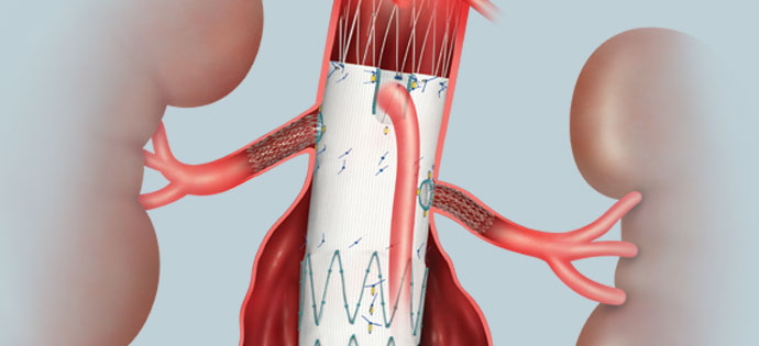 <span class="entry-title-primary">Abdominal Aortic Aneurysm Market Share, Size, Trends, Demand, Key Players and Forecast to 2025</span> <span class="entry-subtitle">Abdominal Aortic Aneurysm Market</span><span class="rating-result after_title mr-filter rating-result-20104">	<span class="mr-star-rating">			    <i class="fa fa-star mr-star-full"></i>	    	    <i class="fa fa-star mr-star-full"></i>	    	    <i class="fa fa-star mr-star-full"></i>	    	    <i class="fa fa-star mr-star-full"></i>	    	    <i class="fa fa-star mr-star-full"></i>	    </span><span class="star-result">	5/5</span>			<span class="count">				(1)			</span>			</span>