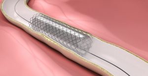 <span class="entry-title-primary">Peripheral Stent Market Report 2025: (Industry Insights, Company Overview and Investment Analysis)</span> <span class="entry-subtitle">Peripheral Stent Market Research</span>