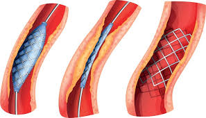 <span class="entry-title-primary">Peripheral Vascular Devices Market | Global Industry Analysis, Segments, Top Key Players, Drivers and Trends to 2025</span> <span class="entry-subtitle">Global Peripheral Vascular Devices Market Research</span>