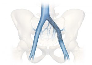 <span class="entry-title-primary">Venous Stents Market Size, Share, Supply, Demand, Segments and Forecast 2019-2025</span> <span class="entry-subtitle">Global Venous Stents Market Research</span>