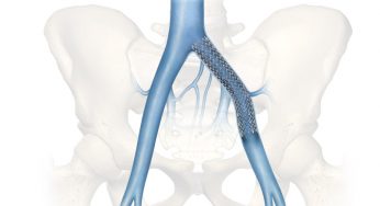 Venous Stents Market Size, Share, Supply, Demand, Segments and Forecast 2019-2025