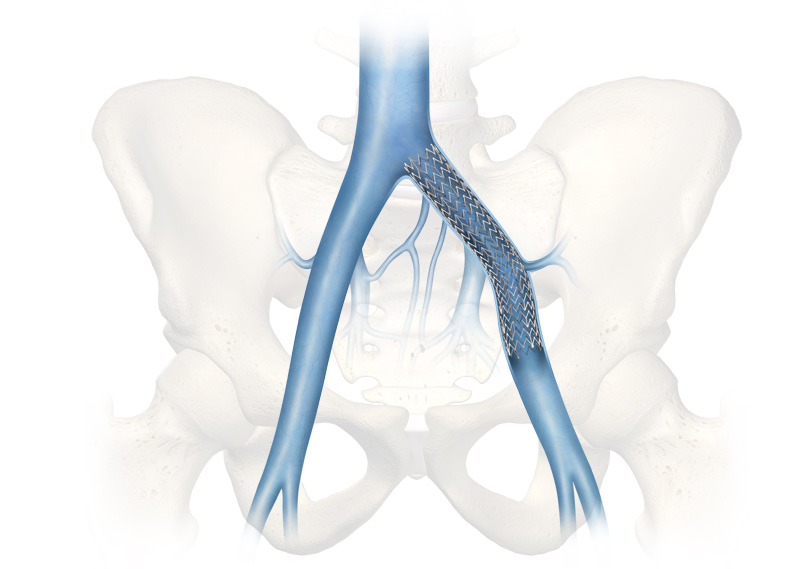 <span class="entry-title-primary">Venous Stents Market Size, Share, Supply, Demand, Segments and Forecast 2019-2025</span> <span class="entry-subtitle">Global Venous Stents Market Research</span><span class="rating-result after_title mr-filter rating-result-18275">	<span class="mr-star-rating">			    <i class="fa fa-star mr-star-full"></i>	    	    <i class="fa fa-star mr-star-full"></i>	    	    <i class="fa fa-star mr-star-full"></i>	    	    <i class="fa fa-star mr-star-full"></i>	    	    <i class="fa fa-star mr-star-full"></i>	    </span><span class="star-result">	5/5</span>			<span class="count">				(1)			</span>			</span>