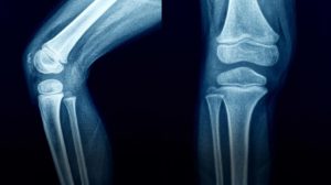 <span class="entry-title-primary">HIP Replacement Market Size, Share, Supply, Demand, Segments and Forecast 2019-2025</span> <span class="entry-subtitle">Global HIP Replacement Market Research:</span>