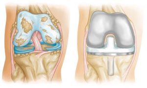 <span class="entry-title-primary">Bone Replacement Market 2019 | Manufacturers, Regions, Type and Application, Forecast to 2025</span> <span class="entry-subtitle">Global Bone Replacement Market Overview:</span>