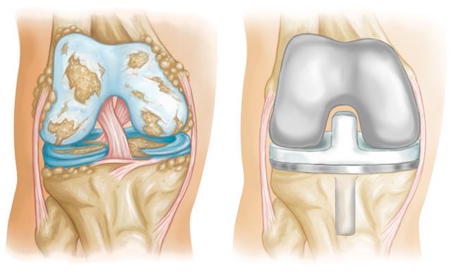 <span class="entry-title-primary">Bone Replacement Market 2019 | Manufacturers, Regions, Type and Application, Forecast to 2025</span> <span class="entry-subtitle">Global Bone Replacement Market Overview:</span><span class="rating-result after_title mr-filter rating-result-26227">	<span class="mr-star-rating">			    <i class="fa fa-star mr-star-full"></i>	    	    <i class="fa fa-star mr-star-full"></i>	    	    <i class="fa fa-star mr-star-full"></i>	    	    <i class="fa fa-star mr-star-full"></i>	    	    <i class="fa fa-star mr-star-full"></i>	    </span><span class="star-result">	5/5</span>			<span class="count">				(1)			</span>			</span>