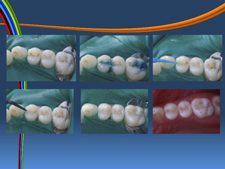 <span class="entry-title-primary">Dental Composite Resins Market: 2019 Global Industry Trends, Growth,Size and 2025 Forecast Research</span> <span class="entry-subtitle">Global Dental Composite Resins Market</span><span class="rating-result after_title mr-filter rating-result-24593">	<span class="mr-star-rating">			    <i class="fa fa-star mr-star-full"></i>	    	    <i class="fa fa-star mr-star-full"></i>	    	    <i class="fa fa-star mr-star-full"></i>	    	    <i class="fa fa-star mr-star-full"></i>	    	    <i class="fa fa-star mr-star-full"></i>	    </span><span class="star-result">	5/5</span>			<span class="count">				(1)			</span>			</span>