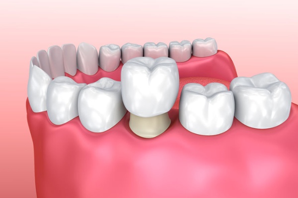 <span class="entry-title-primary">Dental Fittings Market 2019 | Manufacturers, Regions, Type and Application, Forecast to 2025</span> <span class="entry-subtitle">Global Dental Fittings Market Research:</span><span class="rating-result after_title mr-filter rating-result-23482">	<span class="mr-star-rating">			    <i class="fa fa-star mr-star-full"></i>	    	    <i class="fa fa-star mr-star-full"></i>	    	    <i class="fa fa-star mr-star-full"></i>	    	    <i class="fa fa-star mr-star-full"></i>	    	    <i class="fa fa-star mr-star-full"></i>	    </span><span class="star-result">	5/5</span>			<span class="count">				(1)			</span>			</span>