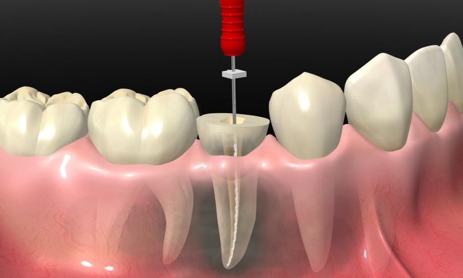 <span class="entry-title-primary">Endodontics Treatments Market by Trends, Key Players, Driver, Segmentation, Forecast to 2025</span> <span class="entry-subtitle">Global Endodontics Treatments Market Research:</span><span class="rating-result after_title mr-filter rating-result-24799">	<span class="mr-star-rating">			    <i class="fa fa-star mr-star-full"></i>	    	    <i class="fa fa-star mr-star-full"></i>	    	    <i class="fa fa-star mr-star-full"></i>	    	    <i class="fa fa-star mr-star-full"></i>	    	    <i class="fa fa-star mr-star-full"></i>	    </span><span class="star-result">	5/5</span>			<span class="count">				(1)			</span>			</span>