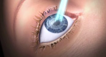 Excimer Laser Market Share, Distributor Analysis and Development Trends 2028