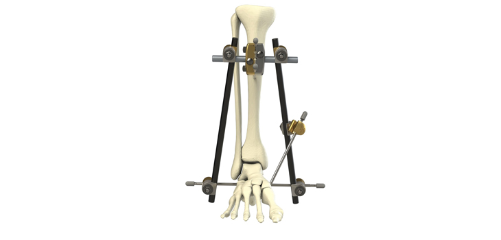 <span class="entry-title-primary">External Fixation Systems Market Size, Share, Growth, Trend and Forecast – 2025</span> <span class="entry-subtitle">Global External Fixation Systems Market Research</span><span class="rating-result after_title mr-filter rating-result-24755">	<span class="mr-star-rating">			    <i class="fa fa-star mr-star-full"></i>	    	    <i class="fa fa-star mr-star-full"></i>	    	    <i class="fa fa-star mr-star-full"></i>	    	    <i class="fa fa-star mr-star-full"></i>	    	    <i class="fa fa-star mr-star-full"></i>	    </span><span class="star-result">	5/5</span>			<span class="count">				(2)			</span>			</span>