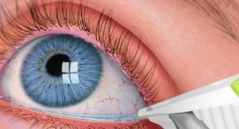Glaucoma Treatment Market share, size,revenue, types, applications and forecast 2019-2025