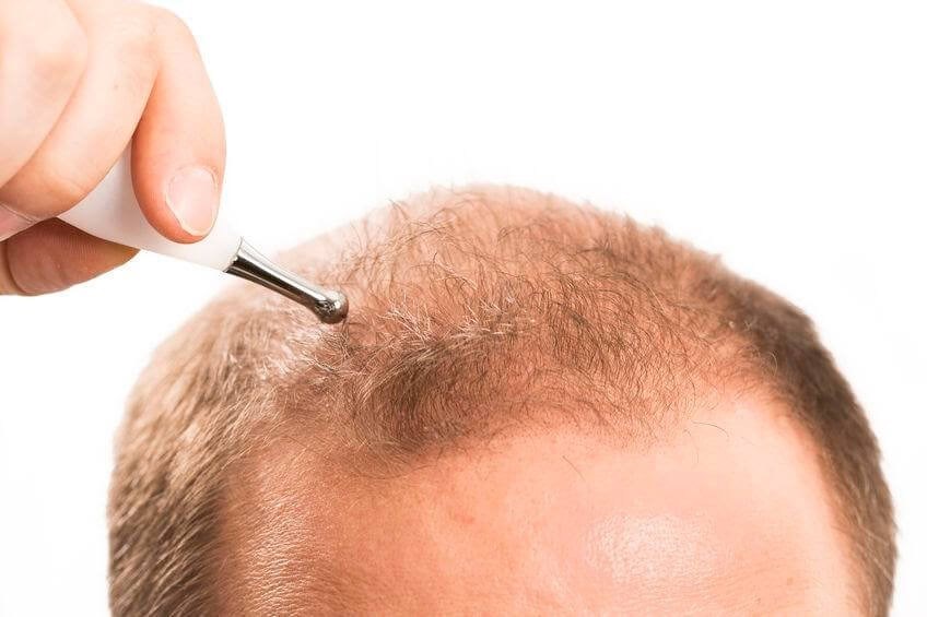 <span class="entry-title-primary">Hair Transplant Market Size, Sales, Trends | Forecast 2025 | Technology</span> <span class="entry-subtitle">Global Hair Transplant Market Research:</span><span class="rating-result after_title mr-filter rating-result-23453">	<span class="mr-star-rating">			    <i class="fa fa-star mr-star-full"></i>	    	    <i class="fa fa-star mr-star-full"></i>	    	    <i class="fa fa-star mr-star-full"></i>	    	    <i class="fa fa-star mr-star-full"></i>	    	    <i class="fa fa-star mr-star-full"></i>	    </span><span class="star-result">	5/5</span>			<span class="count">				(1)			</span>			</span>