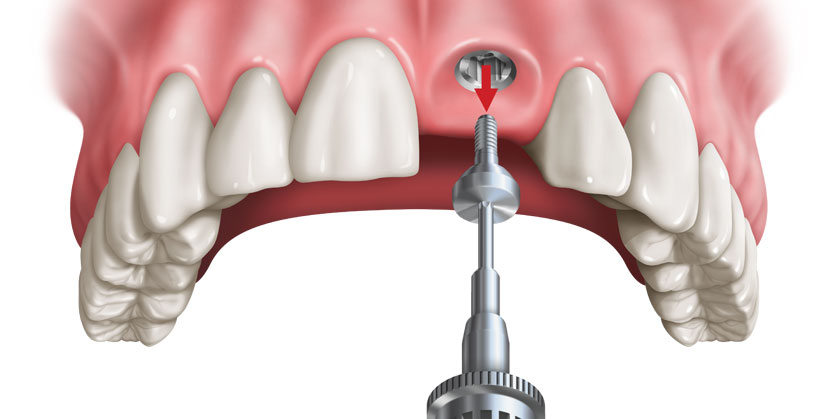 <span class="entry-title-primary">Implant Abutment Market | Manufacturers, Regions, Type and Application, Forecast to 2025</span> <span class="entry-subtitle">Global Implant Abutment Market Research:</span><span class="rating-result after_title mr-filter rating-result-22977">	<span class="mr-star-rating">			    <i class="fa fa-star mr-star-full"></i>	    	    <i class="fa fa-star mr-star-full"></i>	    	    <i class="fa fa-star mr-star-full"></i>	    	    <i class="fa fa-star mr-star-full"></i>	    	    <i class="fa fa-star mr-star-full"></i>	    </span><span class="star-result">	5/5</span>			<span class="count">				(1)			</span>			</span>