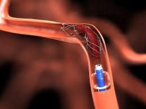 <span class="entry-title-primary">Global Neurovascular Devices Market, Industry Analysis, Size, Research, Development and Forecast to 2028</span> <span class="entry-subtitle">Global Neurovascular Devices market is set to touch US$ 5 Billion by 2025</span><span class="rating-result after_title mr-filter rating-result-21684">	<span class="mr-star-rating">			    <i class="fa fa-star mr-star-full"></i>	    	    <i class="fa fa-star mr-star-full"></i>	    	    <i class="fa fa-star mr-star-full"></i>	    	    <i class="fa fa-star mr-star-full"></i>	    	    <i class="fa fa-star mr-star-full"></i>	    </span><span class="star-result">	5/5</span>			<span class="count">				(1)			</span>			</span>