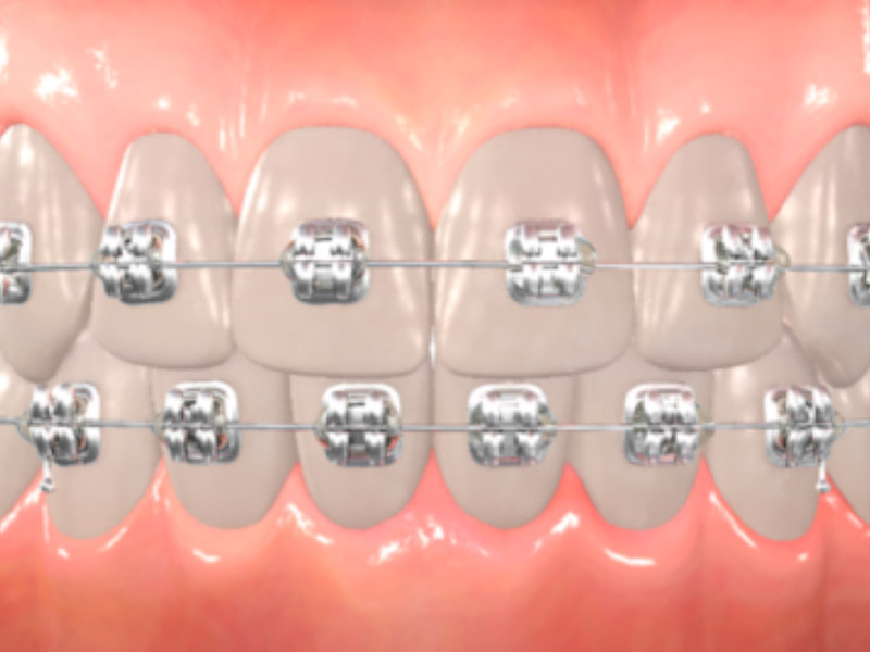 <span class="entry-title-primary">Orthodontic Market 2025 – Global Industry Size, Share, Analysis, Trend And Future Strategic Planning -PMR</span> <span class="entry-subtitle">Global Orthodontic Market Research:</span><span class="rating-result after_title mr-filter rating-result-23878">	<span class="mr-star-rating">			    <i class="fa fa-star mr-star-full"></i>	    	    <i class="fa fa-star mr-star-full"></i>	    	    <i class="fa fa-star mr-star-full"></i>	    	    <i class="fa fa-star mr-star-full"></i>	    	    <i class="fa fa-star mr-star-full"></i>	    </span><span class="star-result">	5/5</span>			<span class="count">				(1)			</span>			</span>