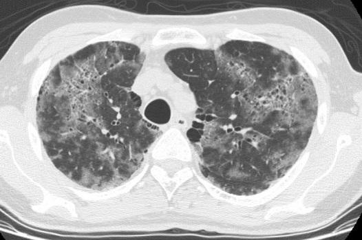 <span class="entry-title-primary">Pneumocystis pneumonia Market: Industry Size, Growth, Analysis And Forecast of 2028</span> <span class="entry-subtitle">Global Pneumocystis pneumonia Market Outlook</span><span class="rating-result after_title mr-filter rating-result-22193">	<span class="mr-star-rating">			    <i class="fa fa-star mr-star-full"></i>	    	    <i class="fa fa-star mr-star-full"></i>	    	    <i class="fa fa-star mr-star-full"></i>	    	    <i class="fa fa-star mr-star-full"></i>	    	    <i class="fa fa-star mr-star-full"></i>	    </span><span class="star-result">	5/5</span>			<span class="count">				(1)			</span>			</span>