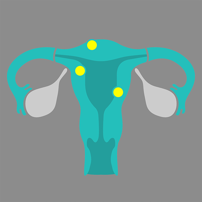 <span class="entry-title-primary">Uterine Fibroids Treatment Market Size 2019 – Application, Trends, Growth and Worldwide Forecast to 2025</span> <span class="entry-subtitle">Global Uterine Fibroids Treatment Market Growth</span><span class="rating-result after_title mr-filter rating-result-25172">	<span class="mr-star-rating">			    <i class="fa fa-star mr-star-full"></i>	    	    <i class="fa fa-star mr-star-full"></i>	    	    <i class="fa fa-star mr-star-full"></i>	    	    <i class="fa fa-star mr-star-full"></i>	    	    <i class="fa fa-star mr-star-full"></i>	    </span><span class="star-result">	5/5</span>			<span class="count">				(1)			</span>			</span>