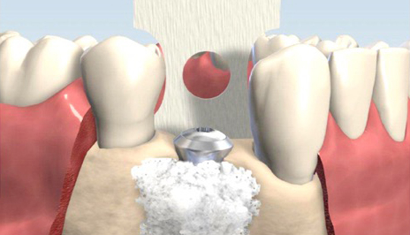 <span class="entry-title-primary">Bone Grafting Market 2019 | Type and Application, Forecast to 2024</span> <span class="entry-subtitle">Bone Grafting Market Industry Size, Growth</span><span class="rating-result after_title mr-filter rating-result-30812">			<span class="no-rating-results-text">No ratings yet.</span>		</span>